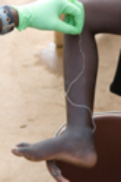 Guinea worm slowly emerging